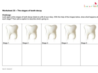 The stages of tooth decay