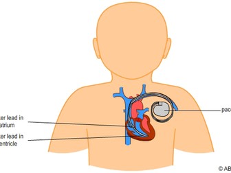 Artificial Pacemaker