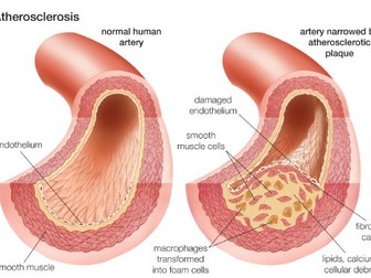 CVD- Atherosclerosis