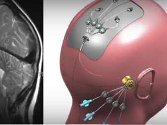 Delivering drugs to the brain