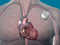 pacemaker inventions ten medical why resource