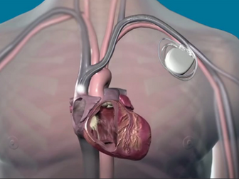 Top ten medical inventions: pacemaker