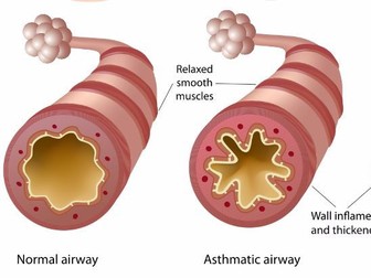 Unit 14 Introduction to Asthma - Physiology, Symptoms, triggers and diagnosis techniques