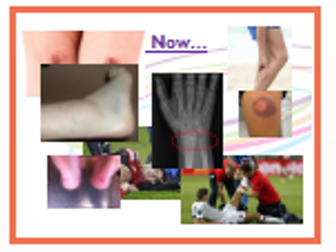 Cambridge National Sports Science Injury Revision Activities