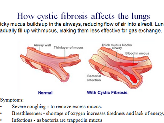 Gene Therapy Cystic fibrosis