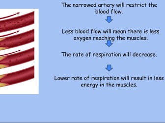 Heart Disease and Stents